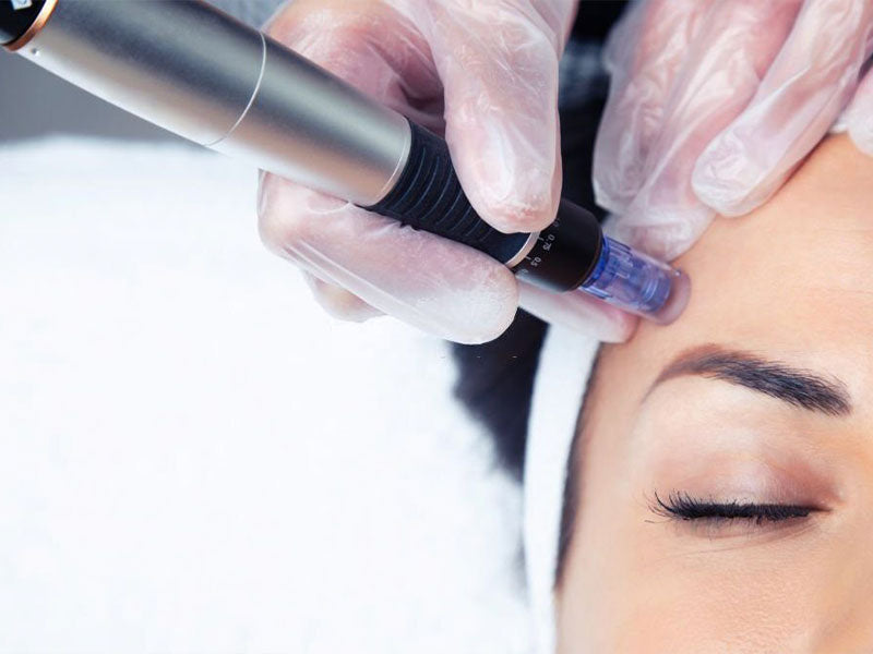 What is mesotherapy and how it can improve your skin?