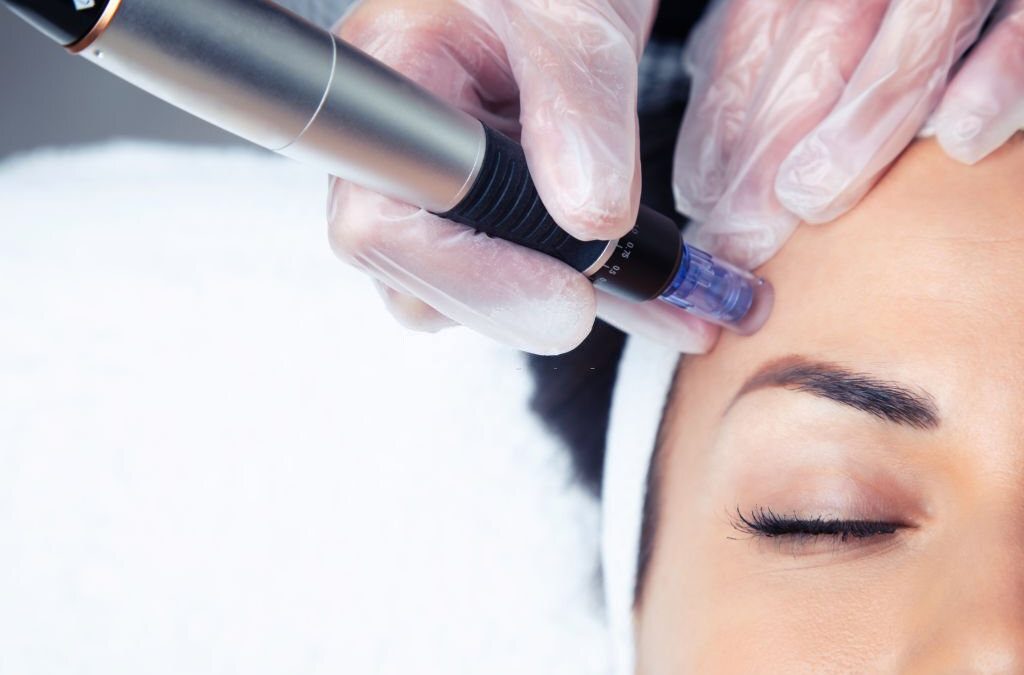 What is mesotherapy and how it can improve your skin?￼